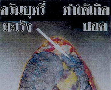 Thailand 2005 Health Effects lung - lung cancer, diseased organ, gross